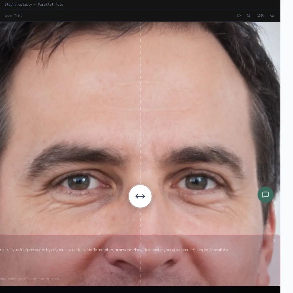 Blepharoplasty — Frontal View — Before