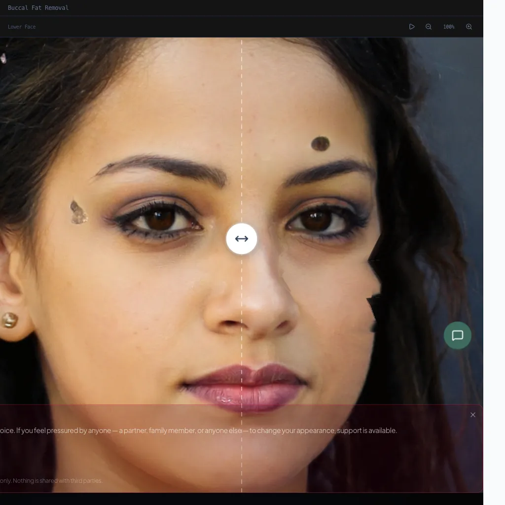 Buccal Fat Removal — Frontal View — Before