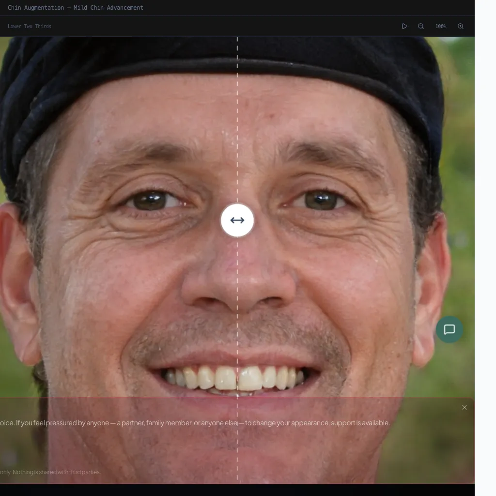 Chin Augmentation — Profile View — Before