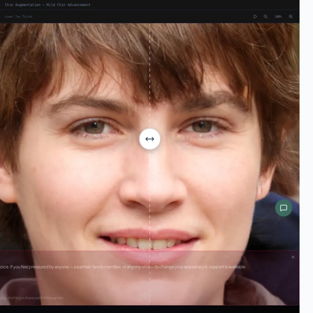 Chin Augmentation — Profile View — After