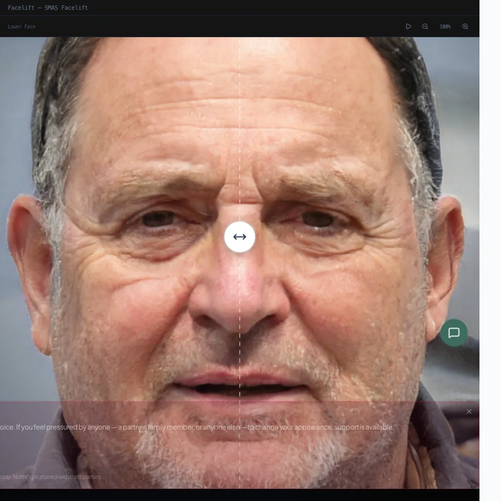 Facelift — Lateral View — Before