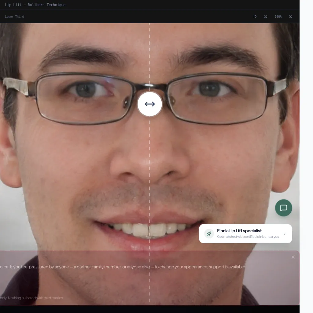 Lip Lift — Frontal View — After