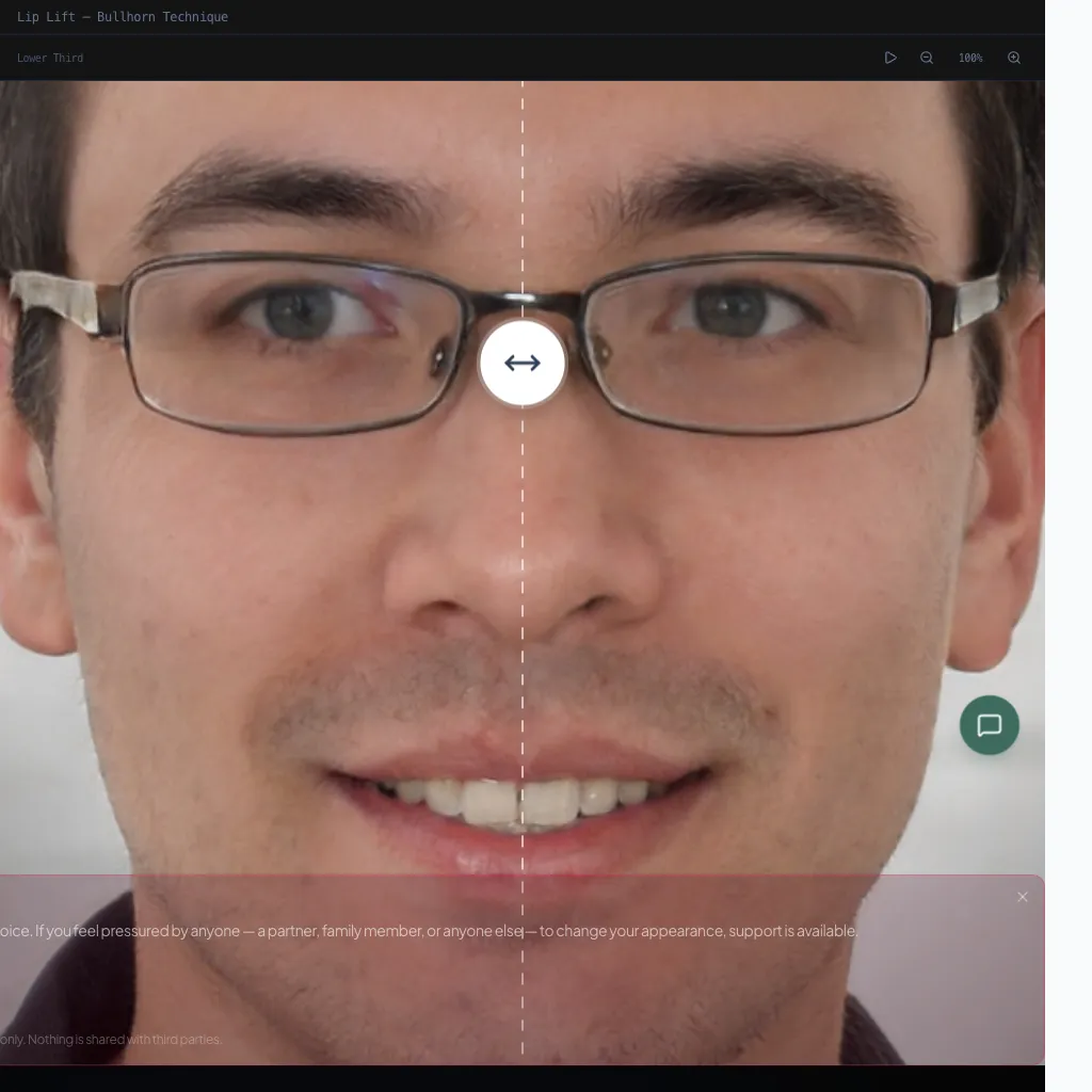 Lip Lift — Frontal View — Before