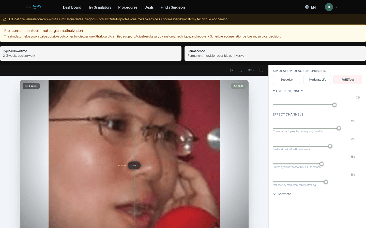 Mid Facelift — AI Simulation Preview · Fixture 1 — Before
