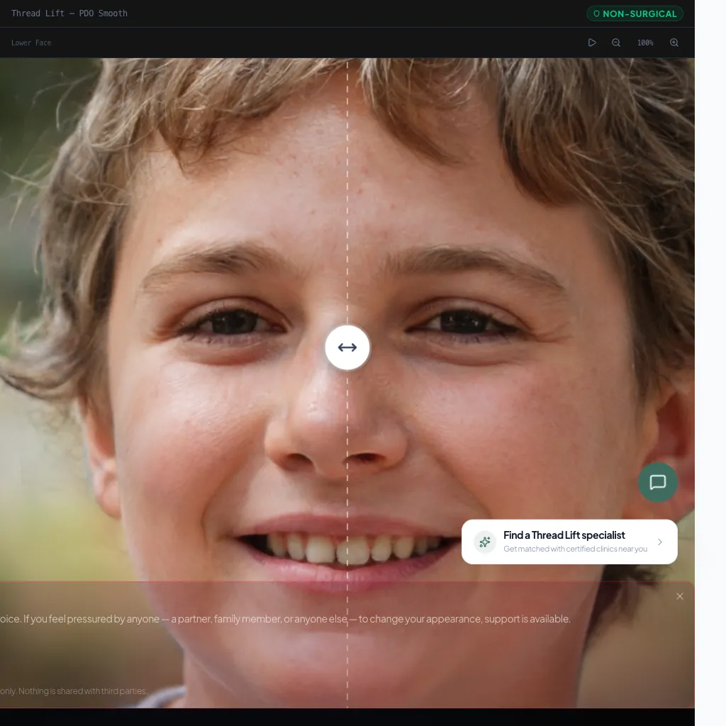 Thread Lift — Oblique View — After